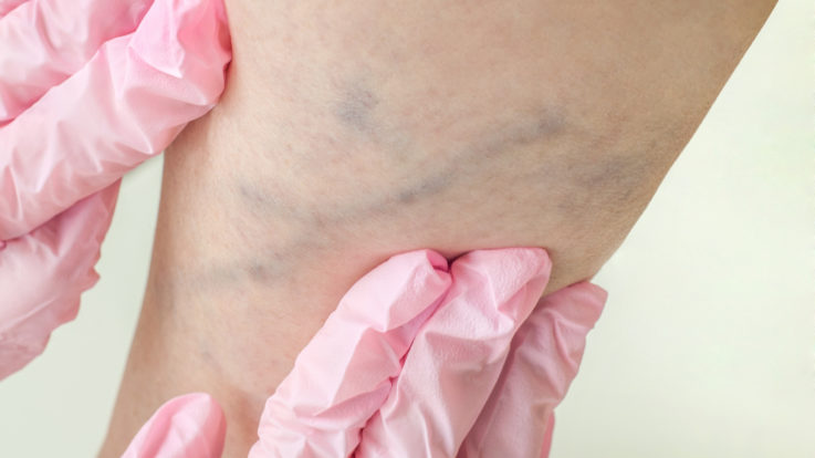 Vein Care Treatments