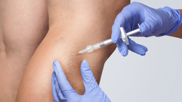 What Is Sclerotherapy? A Comprehensive Guide to This Vein Treatment